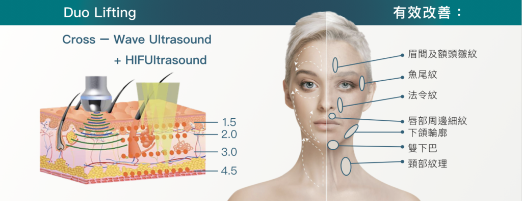 HIFU的原理是甚麼