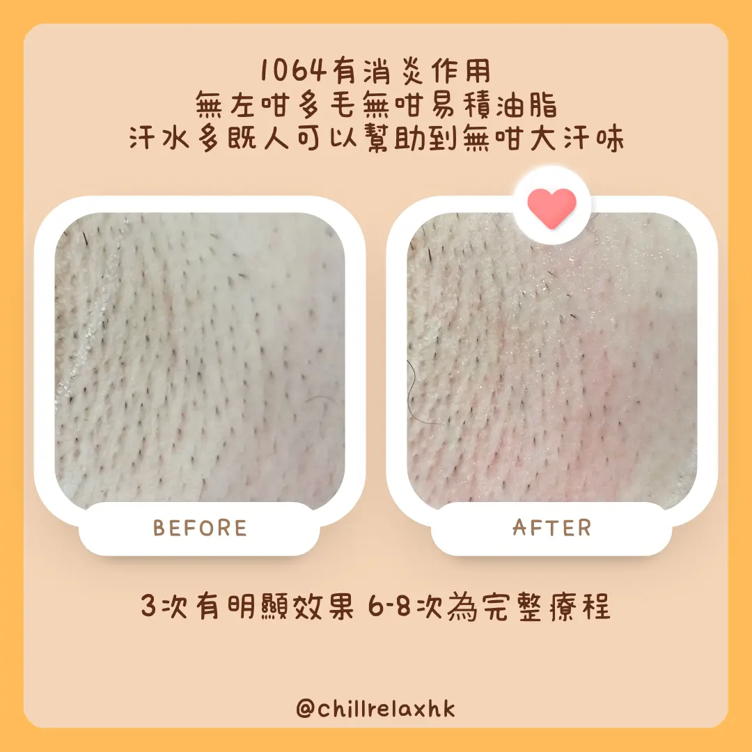 脫毛2