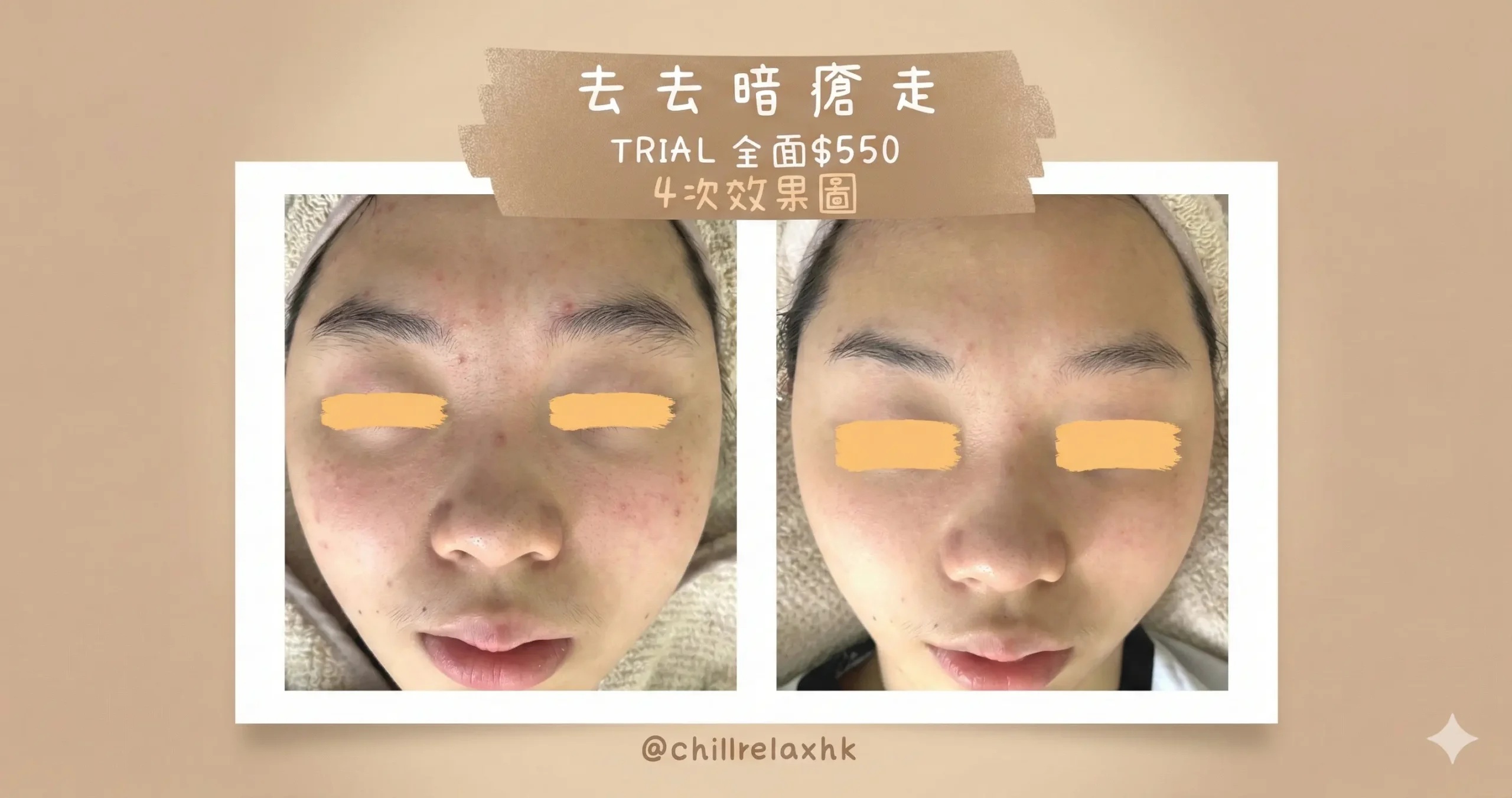 Chillrelaxhk 觀塘美容: 甘醇酸療程效果