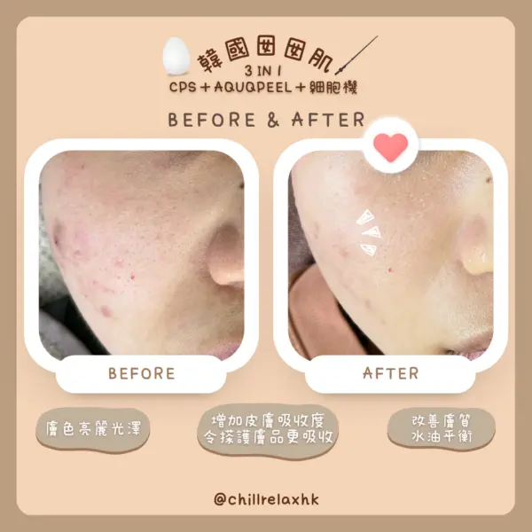 暗瘡一直唔好解決方法 — Chill Relax HK 韓國囡囡肌3=療程效果 | Chill Relax HK 觀塘美容