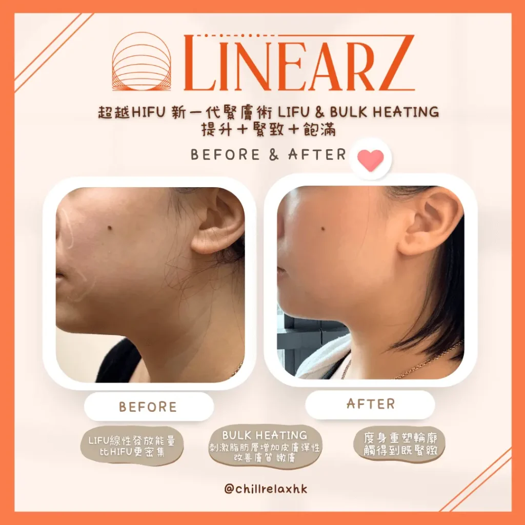 HIFU 效果 — 瘦面拉提前後對比 | Chill Relax HK 觀塘美容