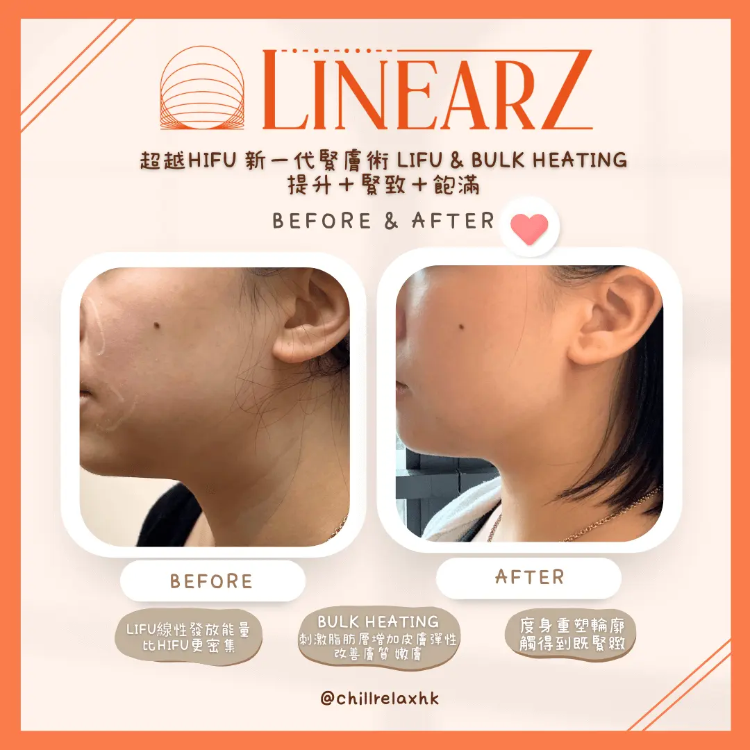 HIFU 效果 — 瘦面拉提前後對比 | Chill Relax HK 觀塘美容