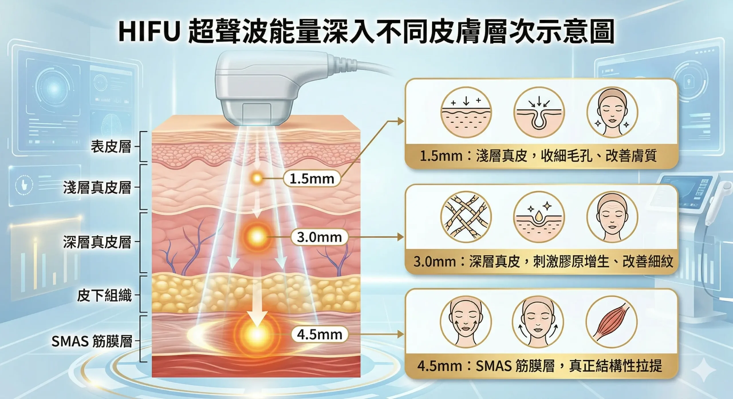 HIFU 原理 — 高能聚焦超聲波深入筋膜層示意圖 | Chill Relax HK 觀塘美容