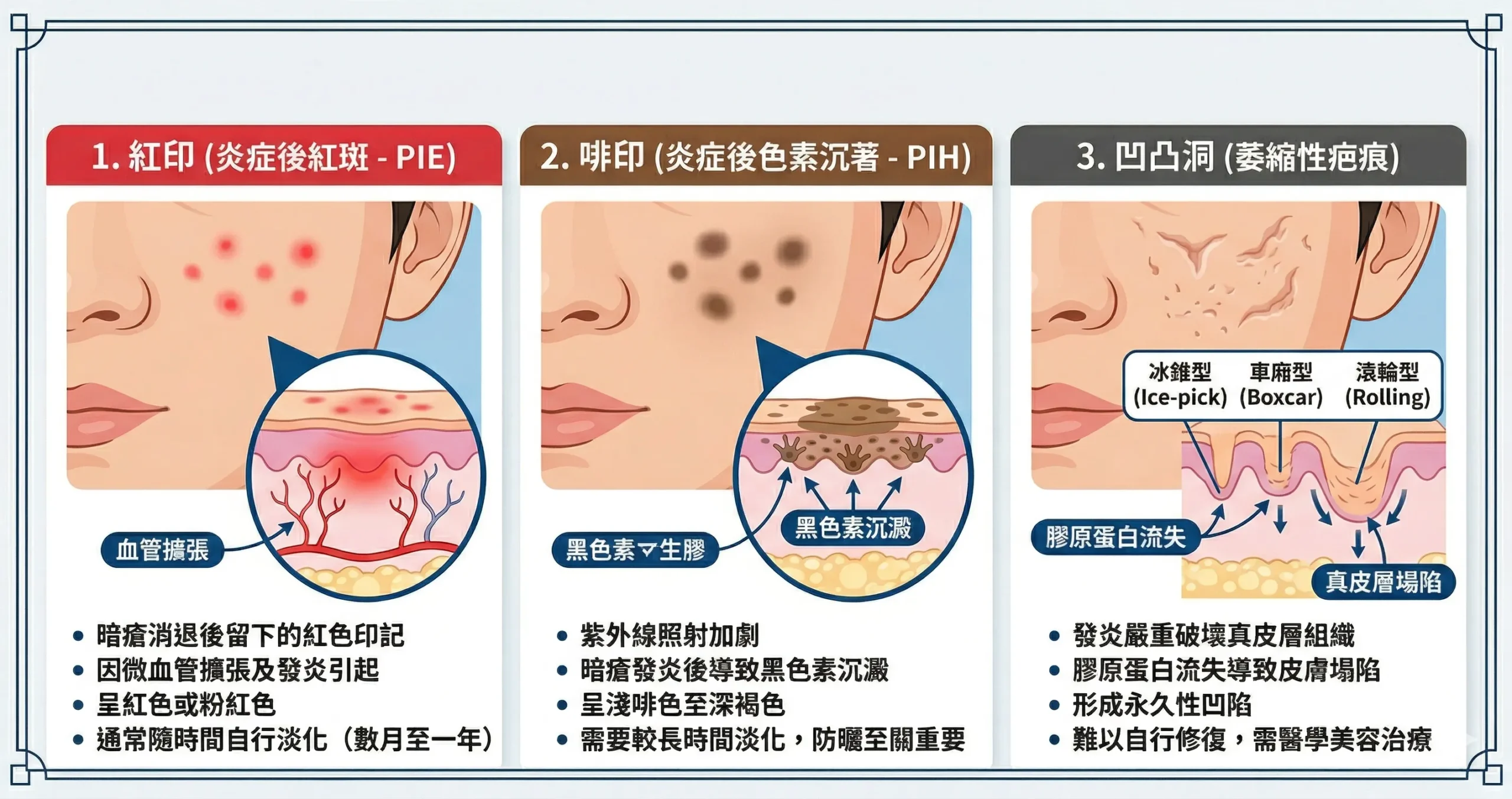 去暗瘡印療程 2026 觀塘｜暗瘡印幾耐退？Pico Laser 淡化【Chill Relax HK】