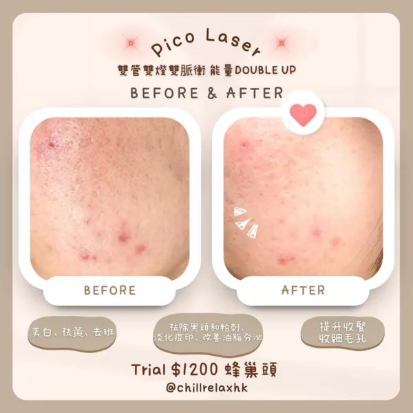 凹凸洞治療 — 觀塘 Chill Relax HK Pico蜂巢激光去凹凸洞效果 | 單次收費美容