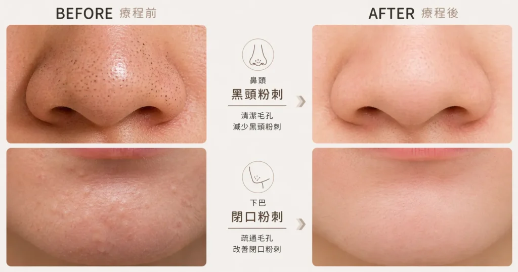 粉刺種類比較 — 黑頭開放性粉刺與閉口白頭粉刺成因 | Chill Relax HK 觀塘美容