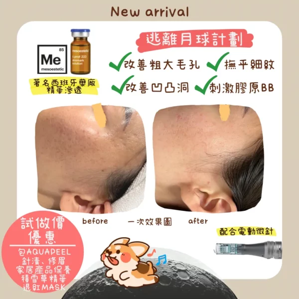 觀塘微針凹凸洞改善前後 — 逃離月球計劃療程效果 | Chill Relax HK