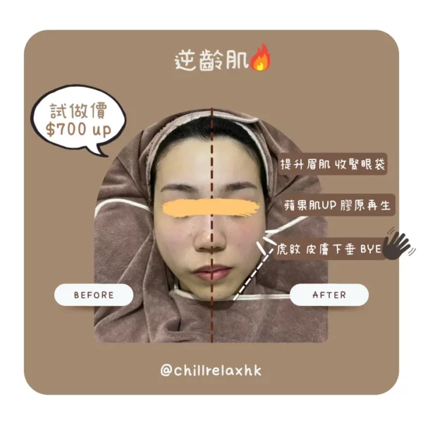 HIFU 雙下巴改善 下顎線 觀塘美容 — Chill Relax HK HIFU 逆齡肌