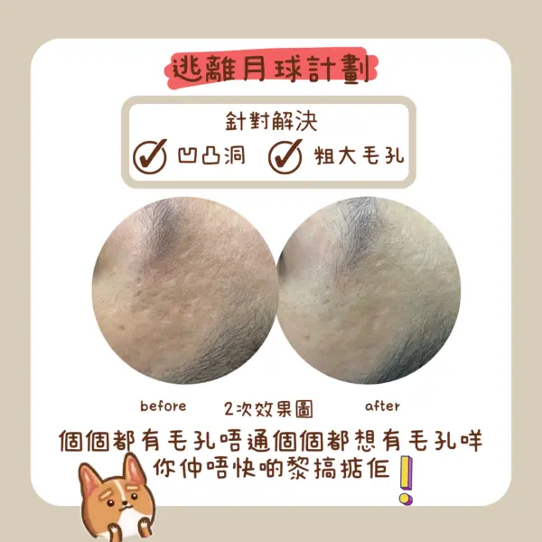 觀塘逃離月球計劃凹凸洞微針療程 — Chill Relax HK 單次收費美容院