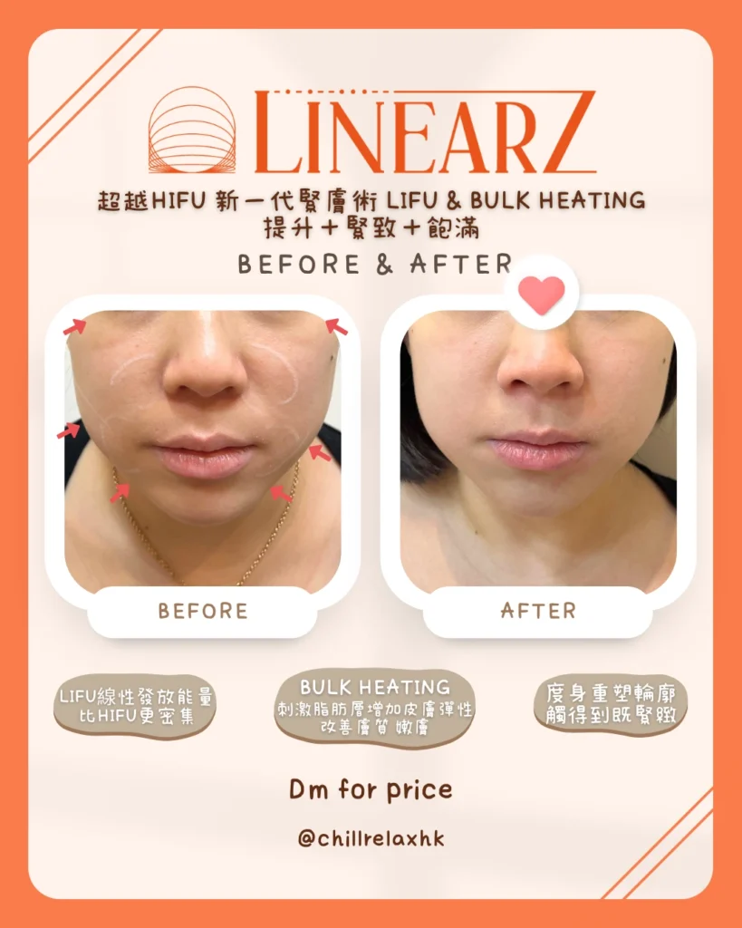 法令紋消除 HIFU 效果 — 觀塘美容院真實改善案例 | Chill Relax HK 觀塘美容