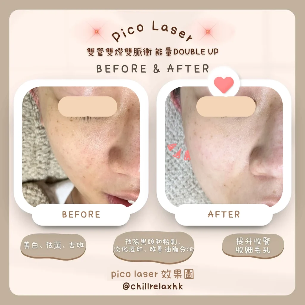 色斑去斑 — 觀塘 Chill Relax HK Pico Laser 皮秒激光去色斑效果 | 單次收費美容