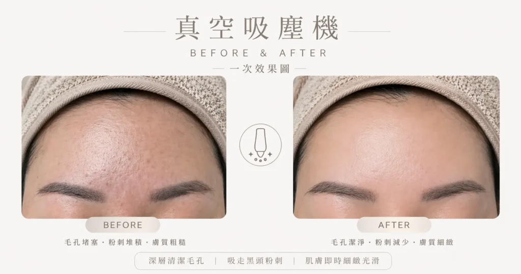 觀塘去粉刺真空吸塵機療程 — 深層清潔毛孔去黑頭白頭 | Chill Relax HK 美容