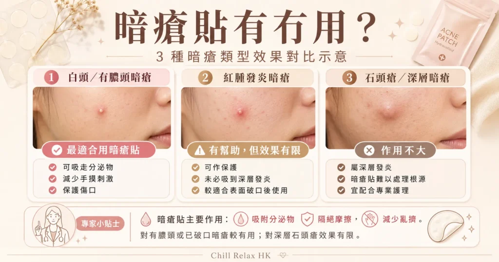 暗瘡貼有冇用 — 3種暗瘡類型效果對比示意 | Chill Relax HK 觀塘美容