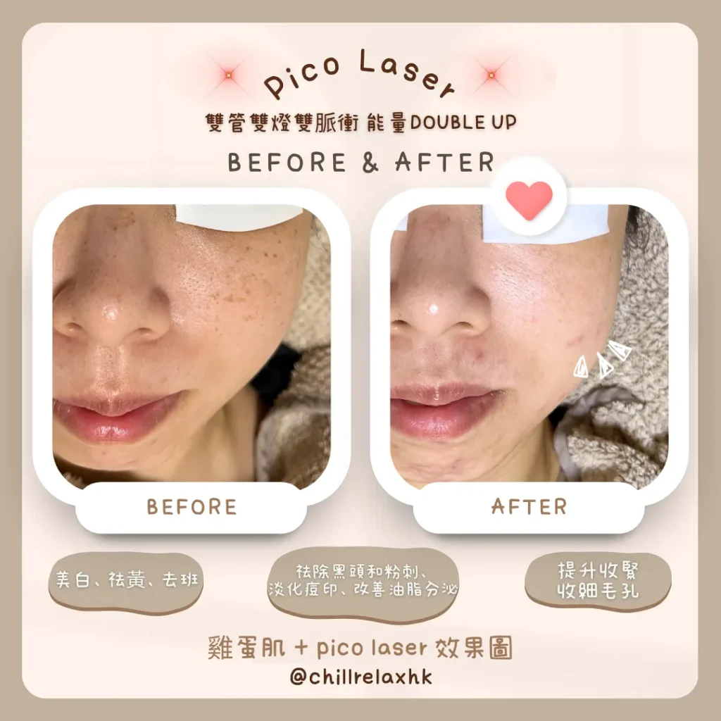 Pico Laser 皮秒激光去印效果 — 觀塘暗瘡印色斑治療前後對比|Chill Relax HK