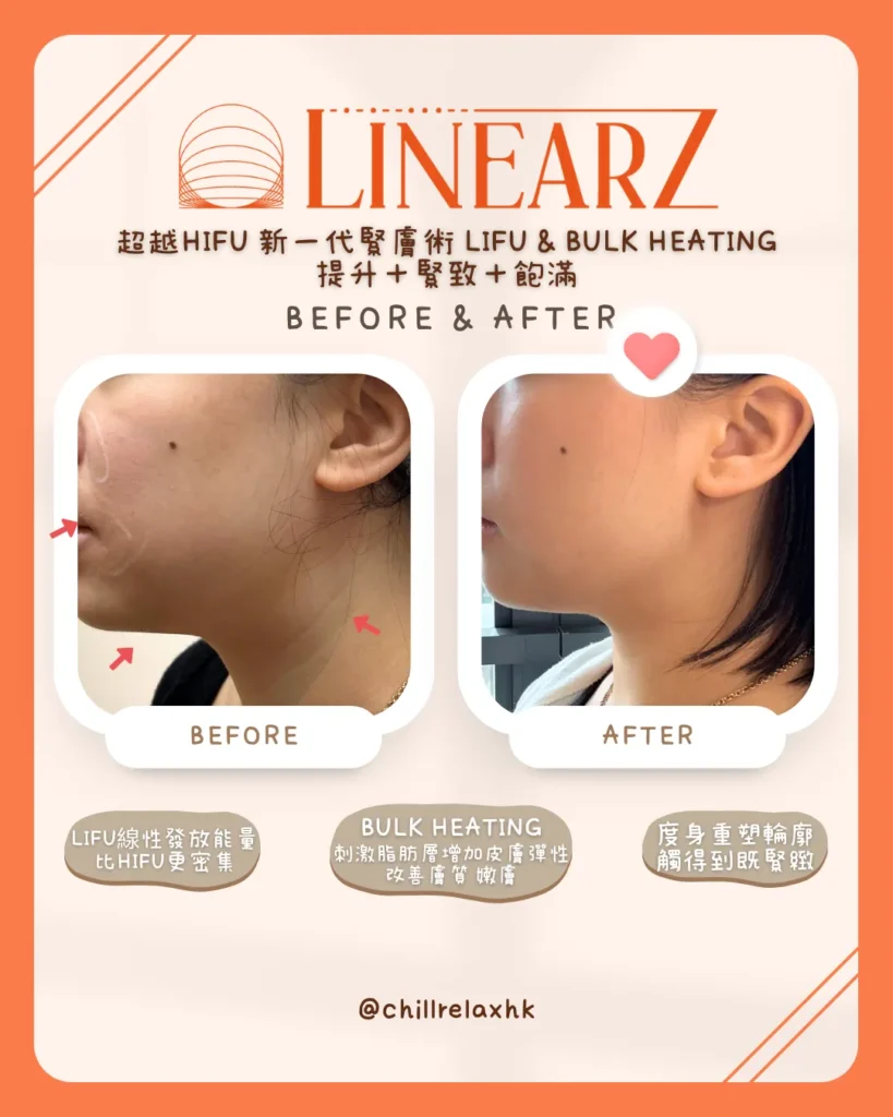觀塘 V 面 HIFU 療程效果 — LinearZ 自然瘦面前後對比|Chill Relax HK