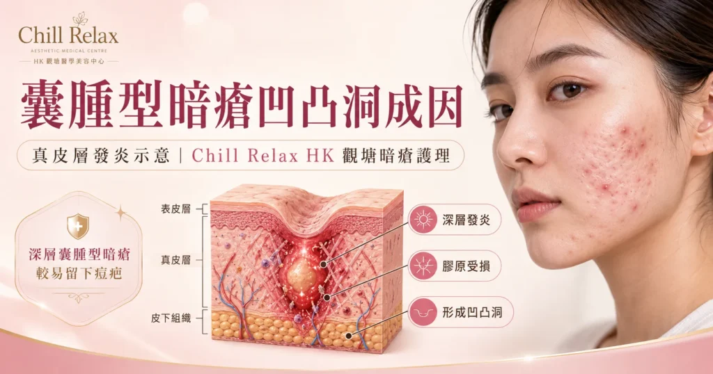 囊腫型暗瘡凹凸洞成因 — 真皮層發炎示意 | Chill Relax HK 觀塘暗瘡護理