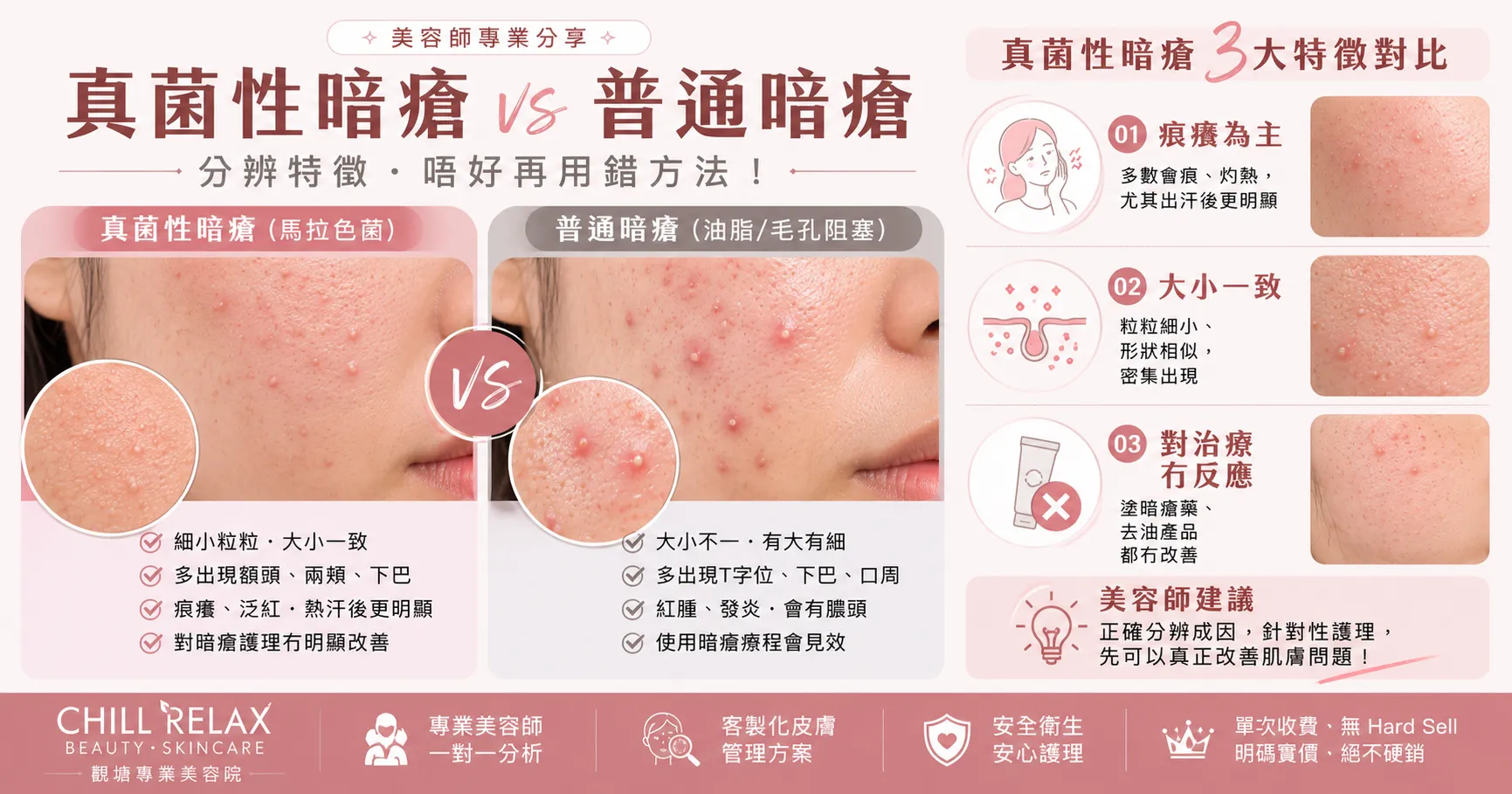 真菌性暗瘡 3大特徵對比 — 痕癢、大小一致、對暗瘡治療冇反應 | Chill Relax HK 觀塘