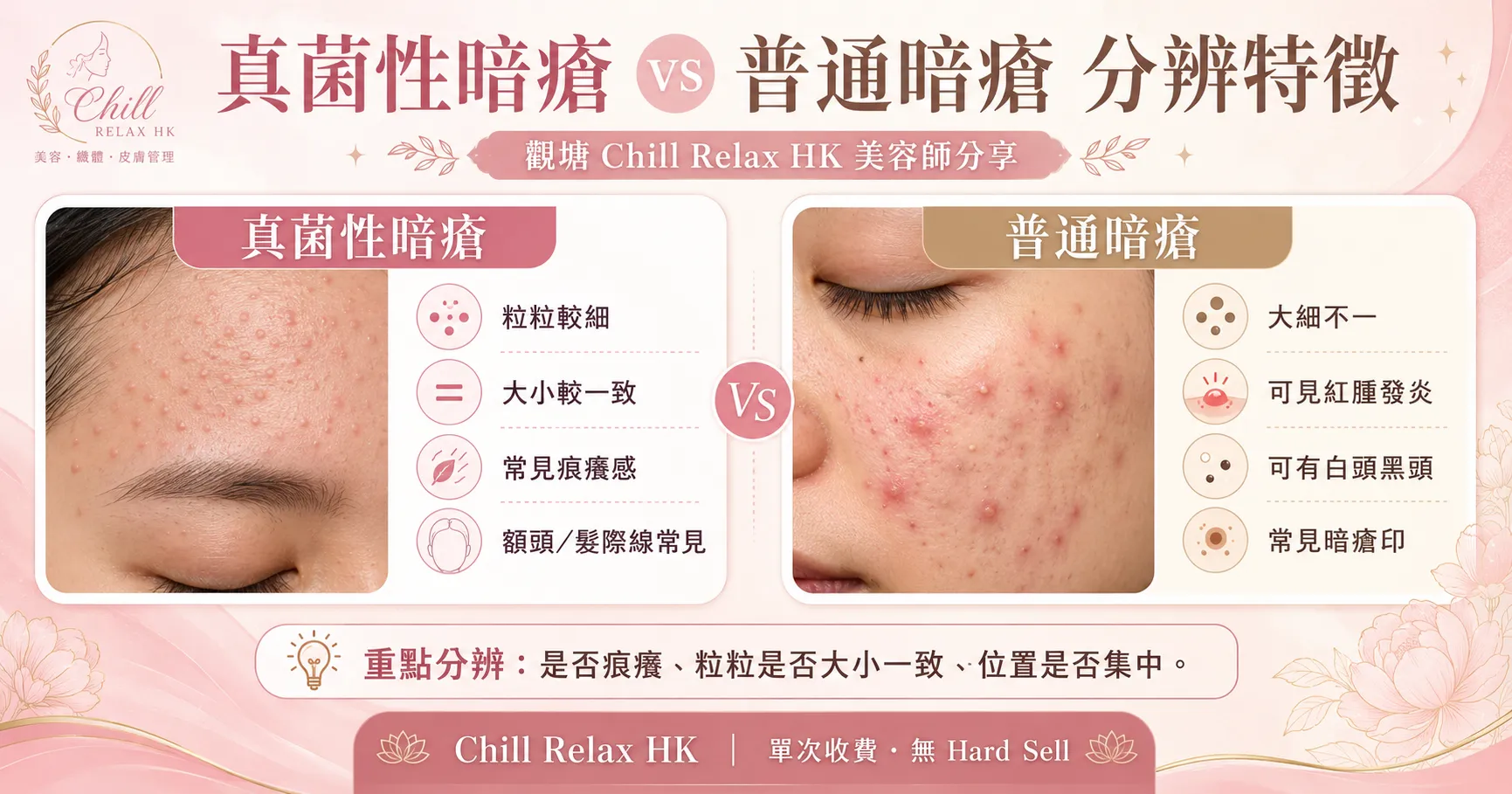 真菌性暗瘡 vs 普通暗瘡 分辨特徵 — 觀塘 Chill Relax HK 美容師分享