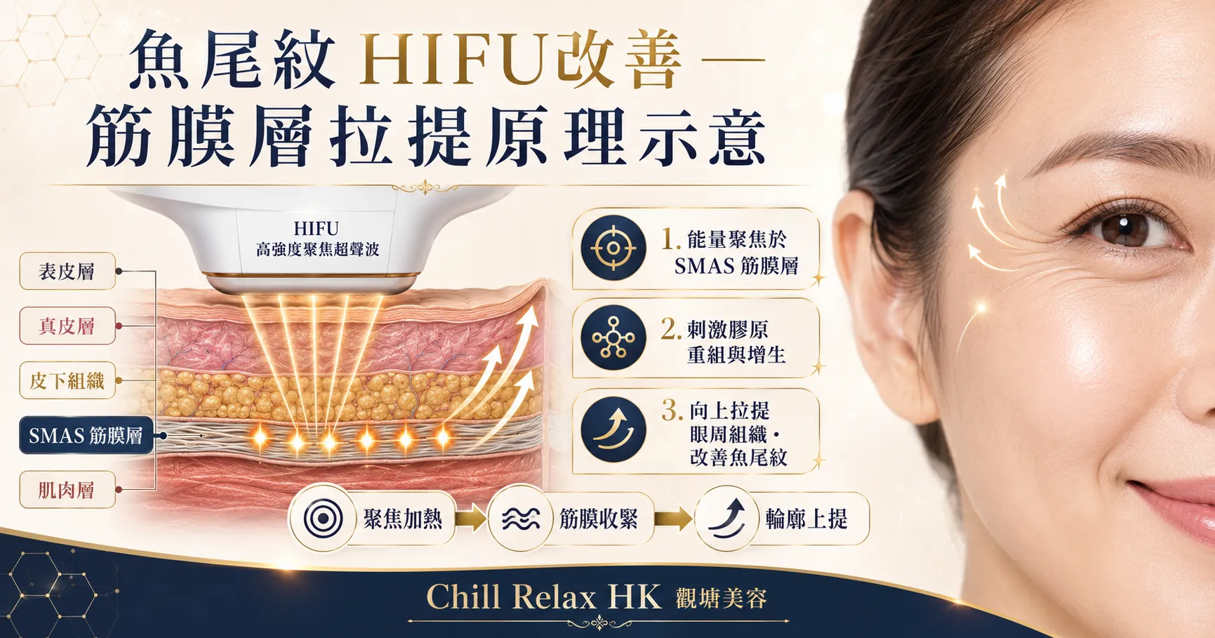 魚尾紋 HIFU改善 — 筋膜層拉提原理示意 | Chill Relax HK 觀塘美容